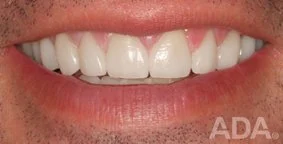 Improving Smile after