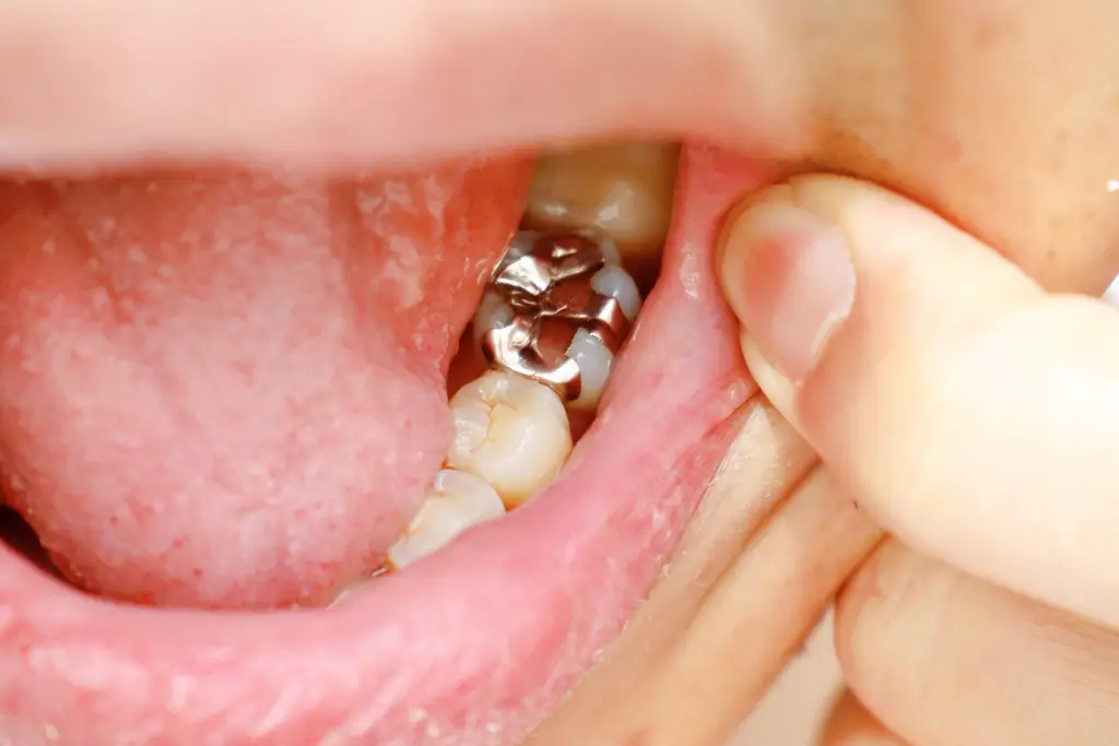 Oral cavity silver coverings are used to treat teeth.