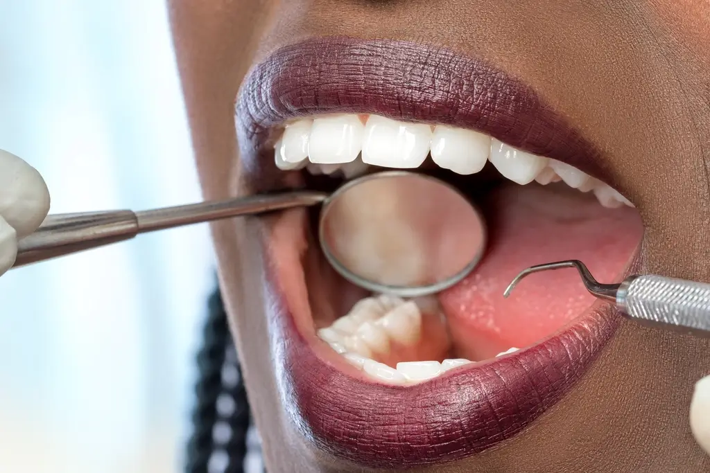 Extreme close up of african woman having dental check up.Open mouth showing perfect white teeth.